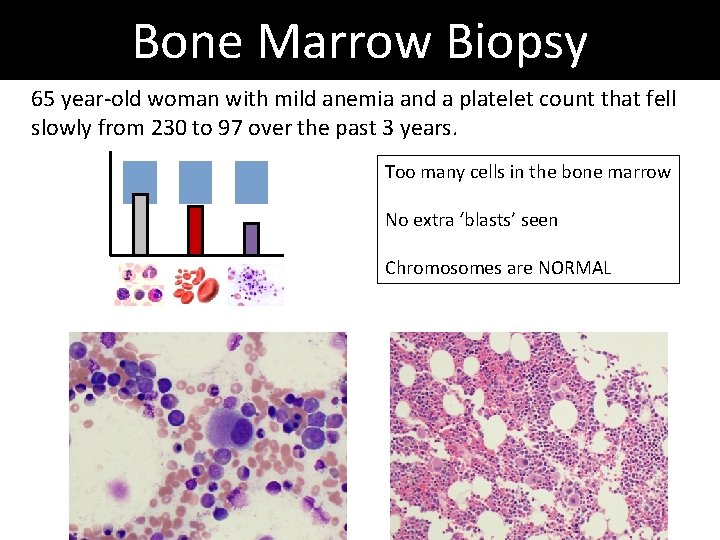 Bone Marrow Biopsy 65 year-old woman with mild anemia and a platelet count that