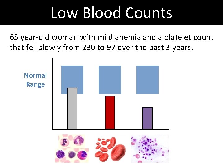 Low Blood Counts 65 year-old woman with mild anemia and a platelet count that