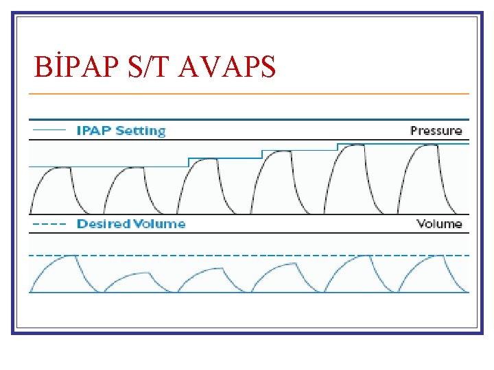 BİPAP S/T AVAPS 