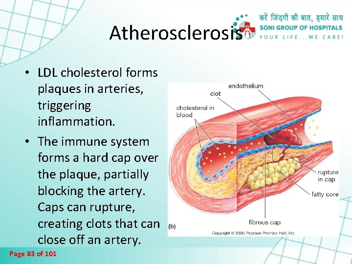 Atherosclerosis • LDL cholesterol forms plaques in arteries, triggering inflammation. • The immune system