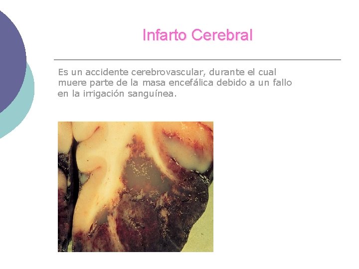 Infarto Cerebral Es un accidente cerebrovascular, durante el cual muere parte de la masa