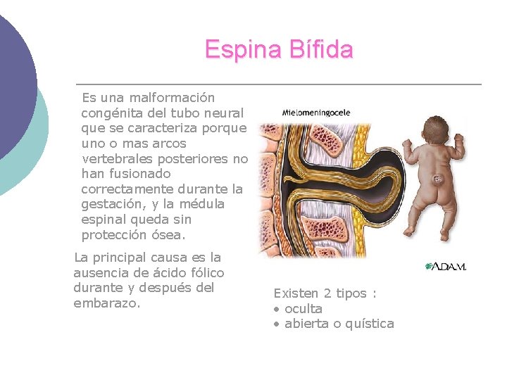 Espina Bífida Es una malformación congénita del tubo neural que se caracteriza porque uno