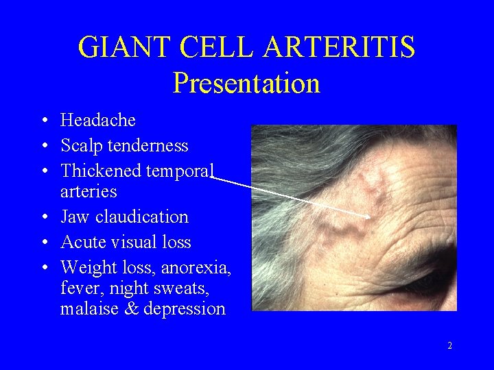GIANT CELL ARTERITIS Presentation • Headache • Scalp tenderness • Thickened temporal arteries •
