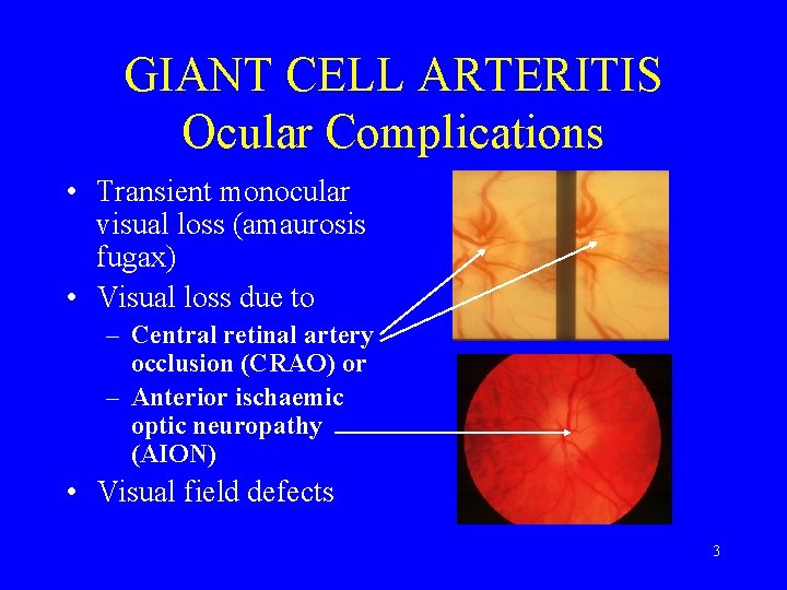 GIANT CELL ARTERITIS Ocular Complications • Transient monocular visual loss (amaurosis fugax) • Visual