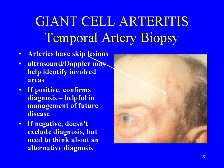 GIANT CELL ARTERITIS Temporal Artery Biopsy • Arteries have skip lesions • ultrasound/Doppler may