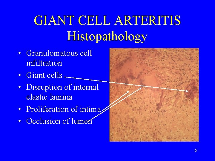 GIANT CELL ARTERITIS Histopathology • Granulomatous cell infiltration • Giant cells • Disruption of