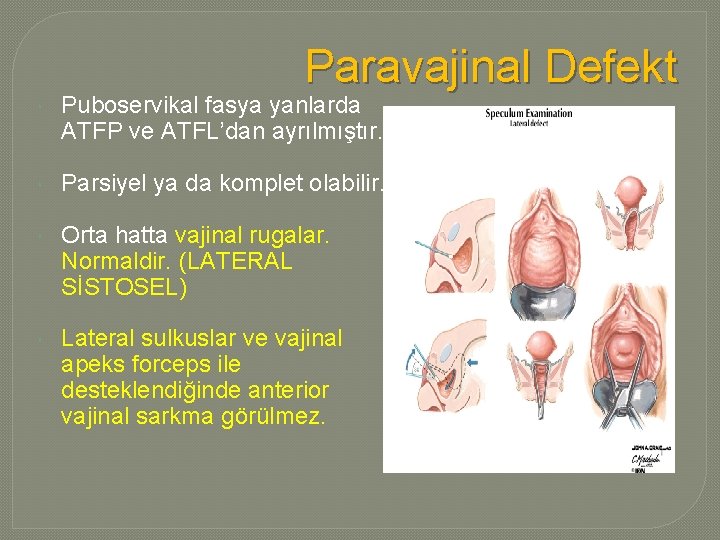 Paravajinal Defekt Puboservikal fasya yanlarda ATFP ve ATFL’dan ayrılmıştır. Parsiyel ya da komplet olabilir.