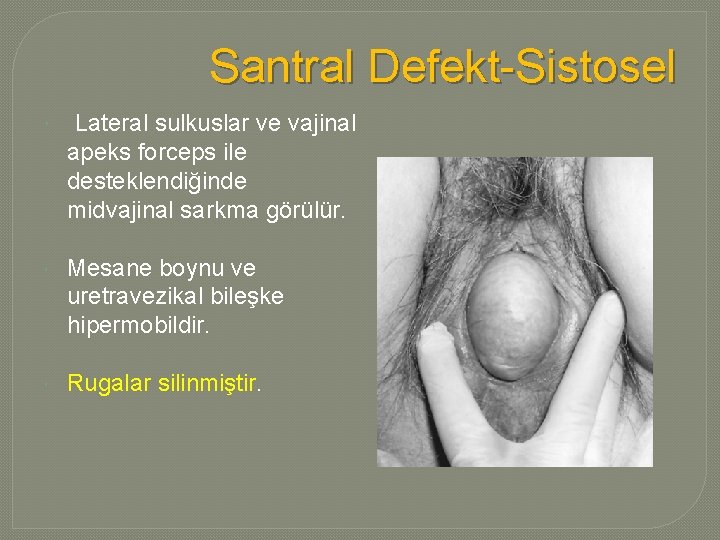 Santral Defekt-Sistosel Lateral sulkuslar ve vajinal apeks forceps ile desteklendiğinde midvajinal sarkma görülür. Mesane