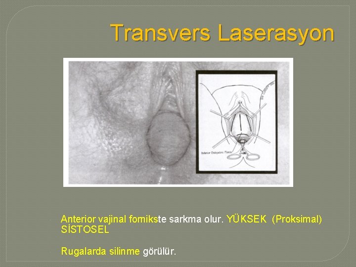 Transvers Laserasyon Anterior vajinal fornikste sarkma olur. YÜKSEK (Proksimal) SİSTOSEL Rugalarda silinme görülür. 