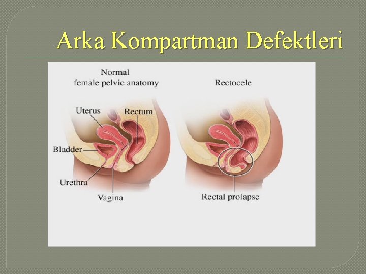 Arka Kompartman Defektleri 