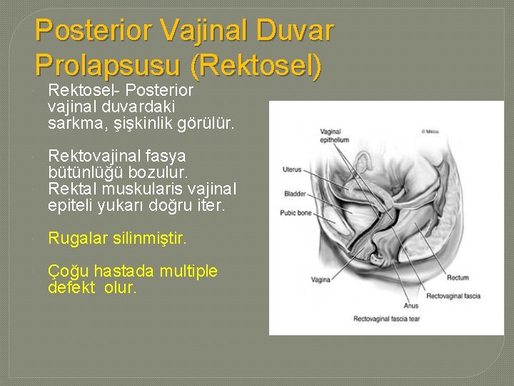 Posterior Vajinal Duvar Prolapsusu (Rektosel) Rektosel- Posterior vajinal duvardaki sarkma, şişkinlik görülür. Rektovajinal fasya