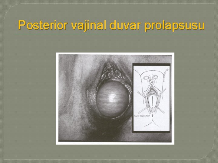 Posterior vajinal duvar prolapsusu 