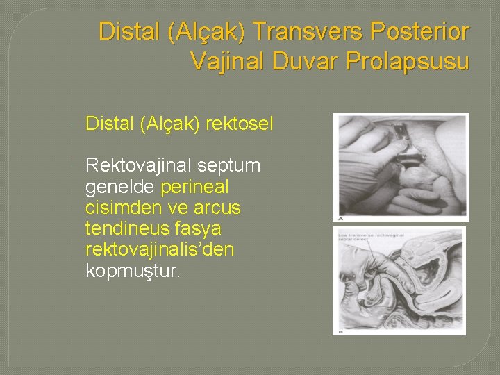 Distal (Alçak) Transvers Posterior Vajinal Duvar Prolapsusu Distal (Alçak) rektosel Rektovajinal septum genelde perineal