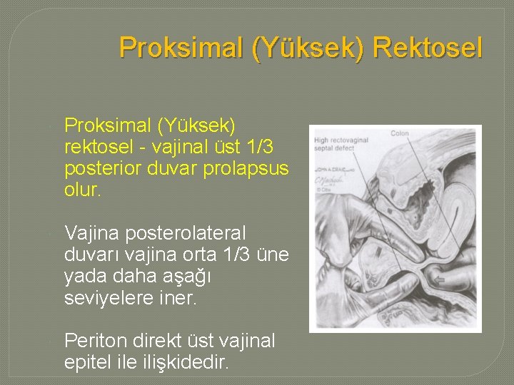 Proksimal (Yüksek) Rektosel Proksimal (Yüksek) rektosel - vajinal üst 1/3 posterior duvar prolapsus olur.