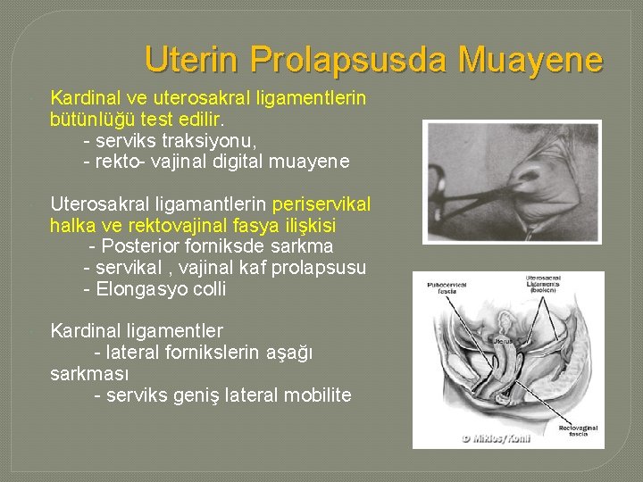 Uterin Prolapsusda Muayene Kardinal ve uterosakral ligamentlerin bütünlüğü test edilir. - serviks traksiyonu, -