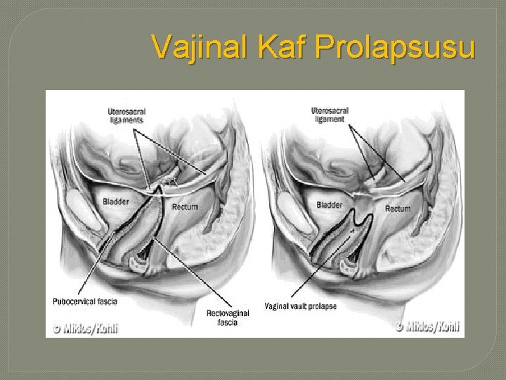 Vajinal Kaf Prolapsusu 