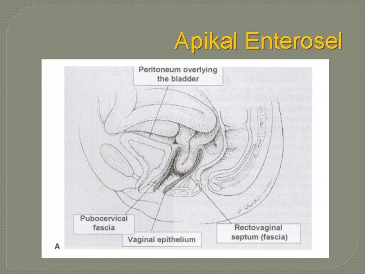 Apikal Enterosel 