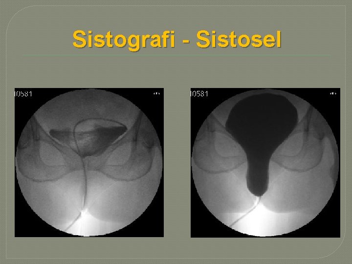 Sistografi - Sistosel 