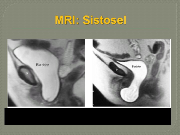 MRI: Sistosel 