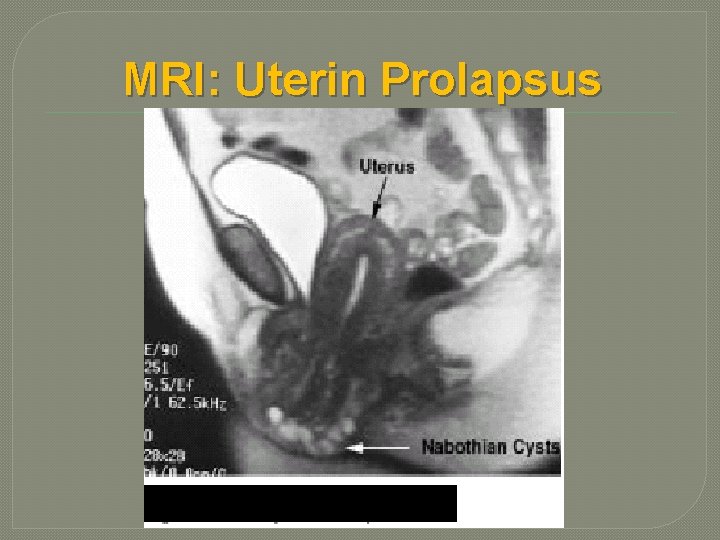 MRI: Uterin Prolapsus 