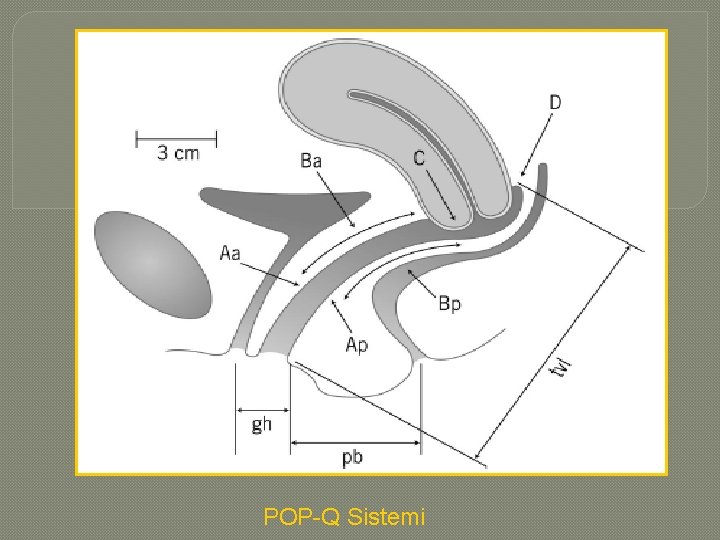 POP-Q Sistemi 