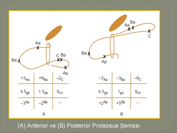 (A) Anterior ve (B) Posterior Prolapsus Şeması (A) Anterior ve (B) Posterior Prolapsus Şeması