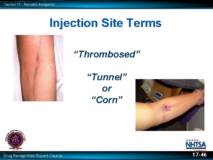 Session 17 – Narcotic Analgesics Injection Site Terms “Thrombosed” “Tunnel” or “Corn” Drug Recognition