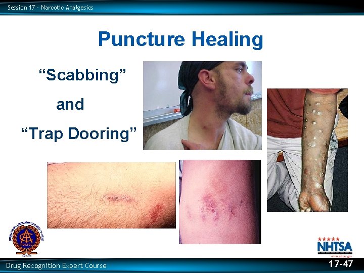 Session 17 – Narcotic Analgesics Puncture Healing “Scabbing” and “Trap Dooring” Drug Recognition Expert