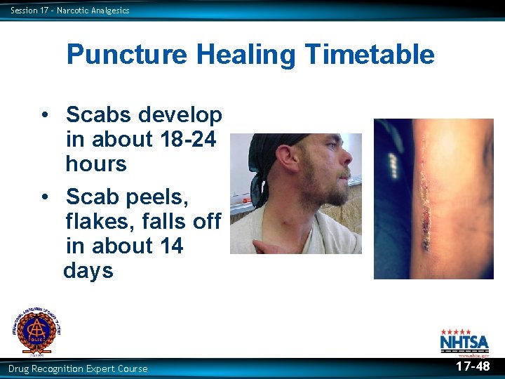 Session 17 – Narcotic Analgesics Puncture Healing Timetable • Scabs develop in about 18