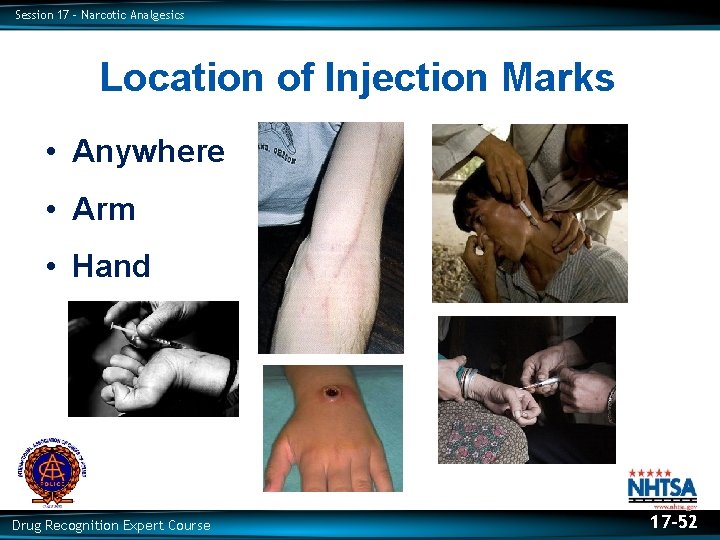 Session 17 – Narcotic Analgesics Location of Injection Marks • Anywhere • Arm •