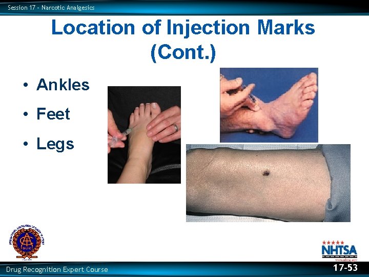 Session 17 – Narcotic Analgesics Location of Injection Marks (Cont. ) • Ankles •