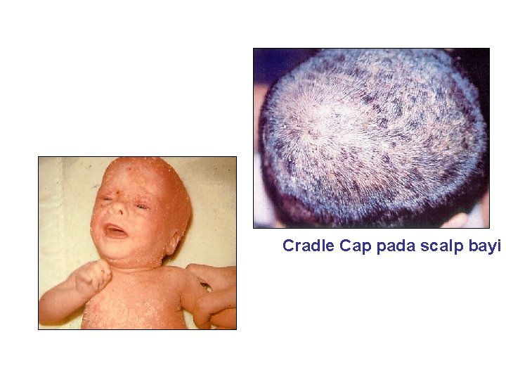 Cradle Cap pada scalp bayi 