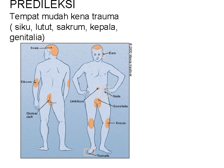 PREDILEKSI Tempat mudah kena trauma ( siku, lutut, sakrum, kepala, genitalia) 