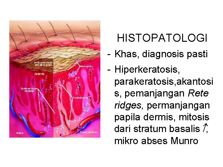  HISTOPATOLOGI - Khas, diagnosis pasti - Hiperkeratosis, parakeratosis, akantosi s, pemanjangan Rete ridges,