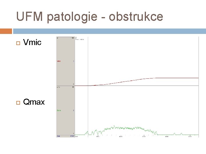 UFM patologie - obstrukce Vmic Qmax 