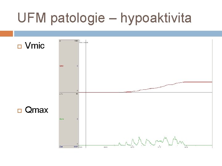 UFM patologie – hypoaktivita Vmic Qmax 