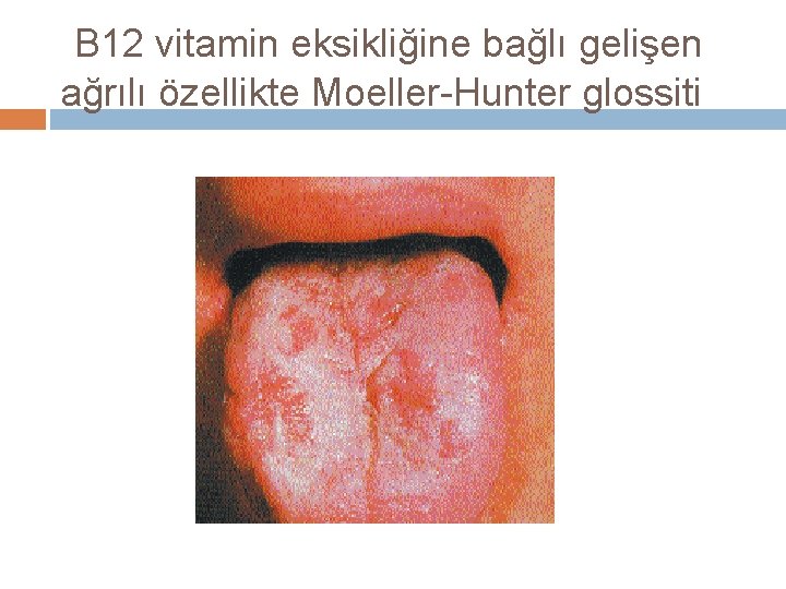 B 12 vitamin eksikliğine bağlı gelişen ağrılı özellikte Moeller-Hunter glossiti 