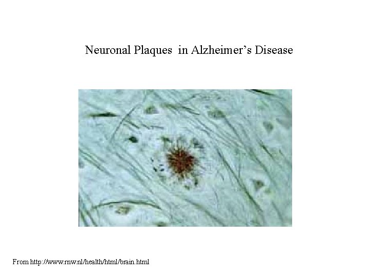Neuronal Plaques in Alzheimer’s Disease From http: //www. rnw. nl/health/html/brain. html 