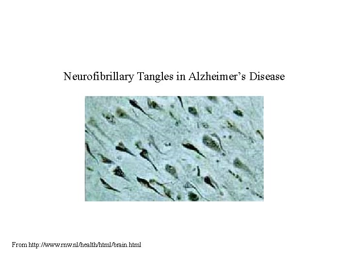 Neurofibrillary Tangles in Alzheimer’s Disease From http: //www. rnw. nl/health/html/brain. html 