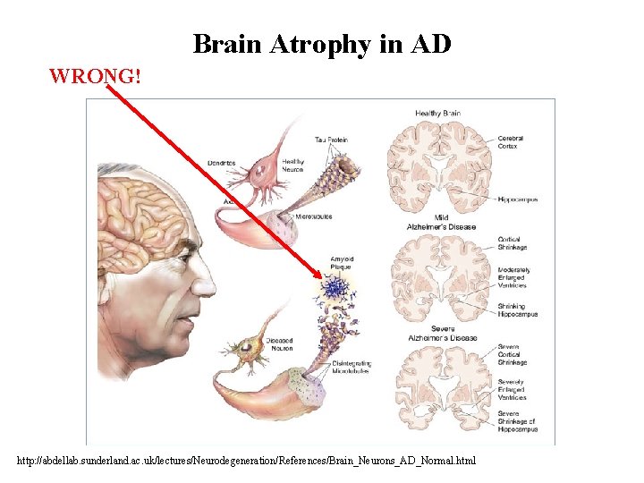 Brain Atrophy in AD WRONG! http: //abdellab. sunderland. ac. uk/lectures/Neurodegeneration/References/Brain_Neurons_AD_Normal. html 