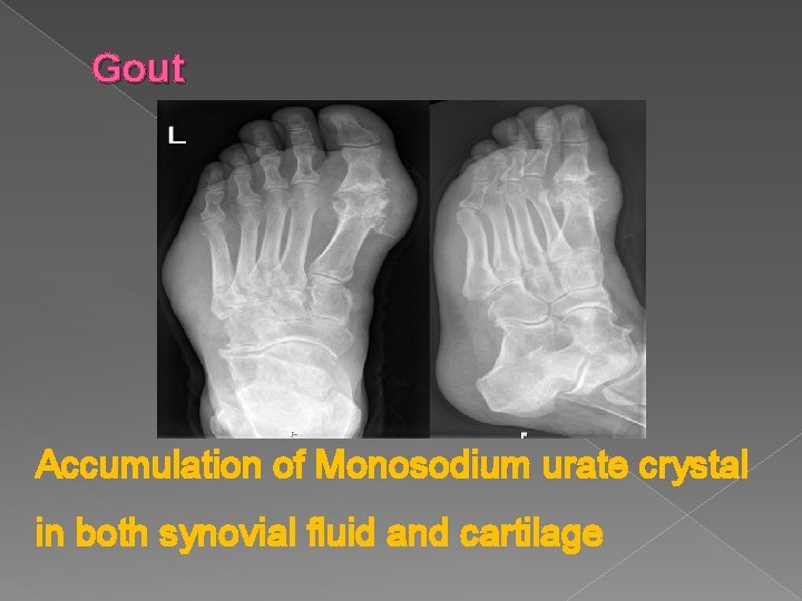 Gout Accumulation of Monosodium urate crystal in both synovial fluid and cartilage 