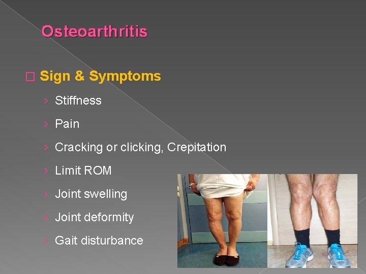 Osteoarthritis � Sign & Symptoms › Stiffness › Pain › Cracking or clicking, Crepitation