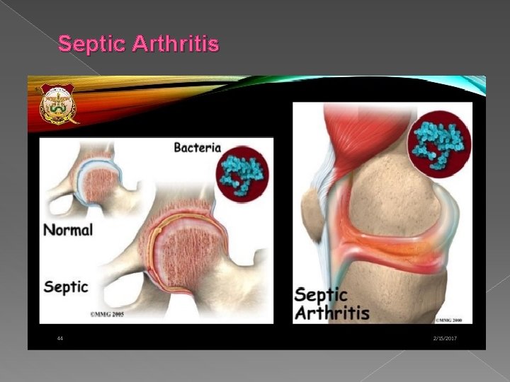 Septic Arthritis 