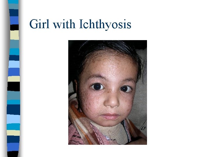 Girl with Ichthyosis 