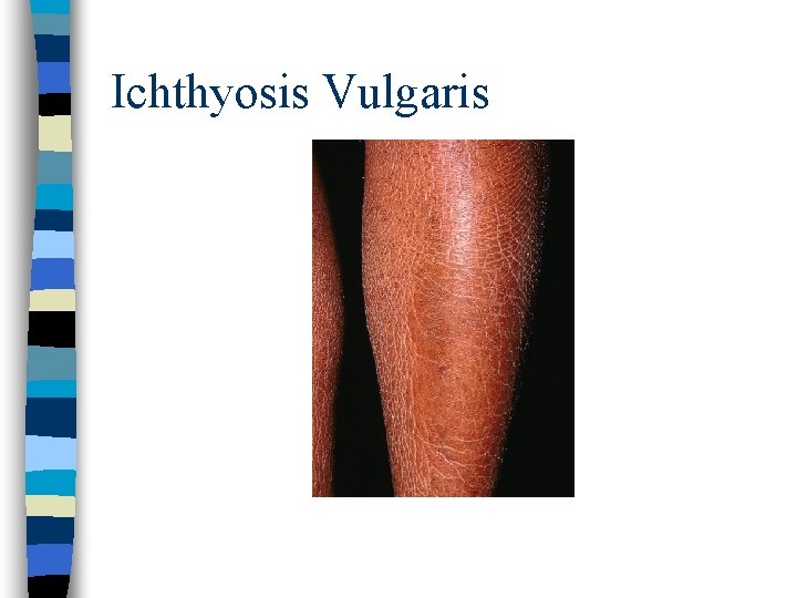 Ichthyosis Vulgaris Ichthyosis Vulgaris