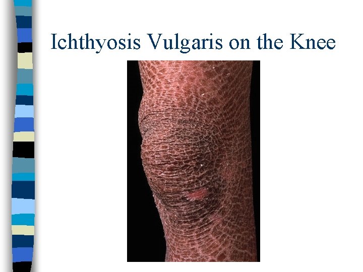 Ichthyosis Vulgaris on the Knee 