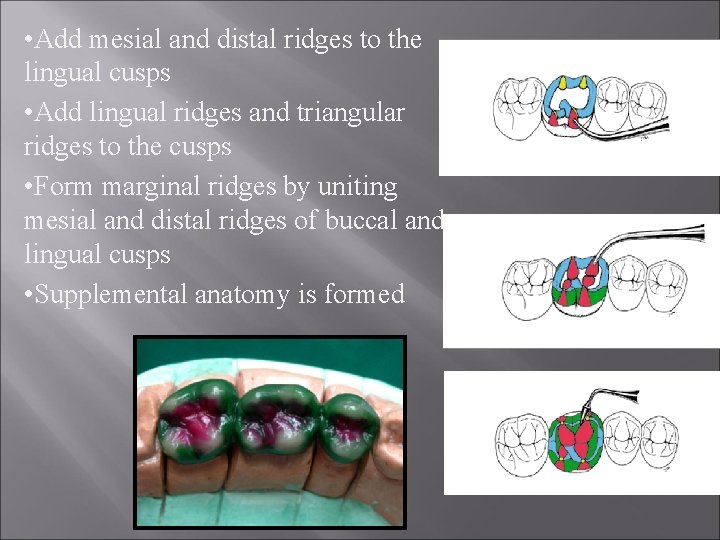  • Add mesial and distal ridges to the lingual cusps • Add lingual