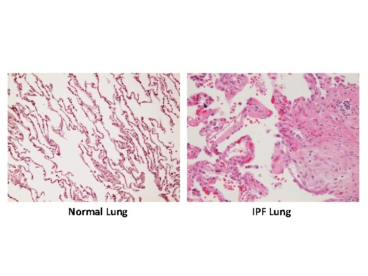 Normal Lung IPF Lung 