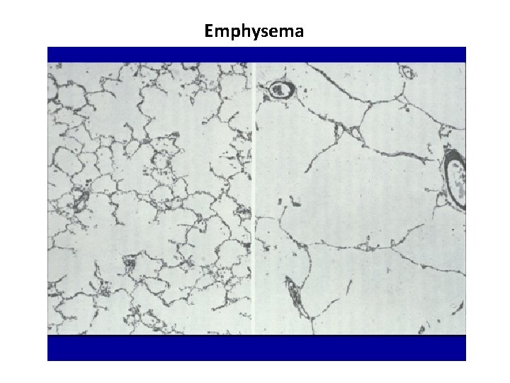 Emphysema 