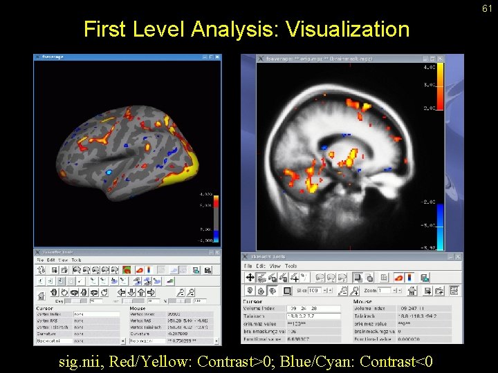 61 First Level Analysis: Visualization sig. nii, Red/Yellow: Contrast>0; Blue/Cyan: Contrast<0 